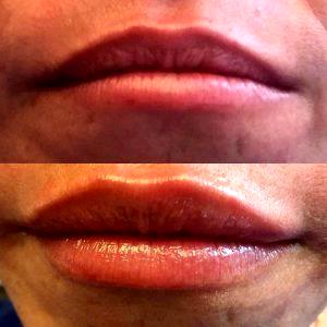 Filler For Lips by Dr. Steven H. Dayan, MD, Doctor in Chicago, Illinois