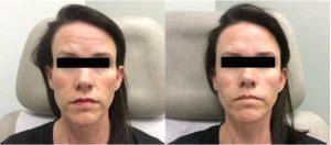 Filler To Temples And Midface By Dustin Reid, MD, FACS , Austin Plastic Surgeon
