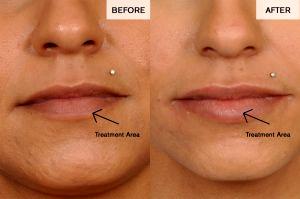 Filler To The Lips By Dr. David Broadway, Denver Plastic Surgeon