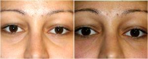 Filler for dark under eye circles by Dr. Otto J. Placik, Chicago Plastic Surgeon (2)
