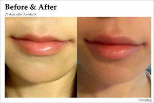 Fillers And Botox At Just Face It MedSpa, Medical Spa In The Clark County, Nevada (15)