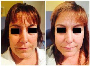 Fillers And Botox At Just Face It MedSpa, Medical Spa In The Clark County, Nevada (16)