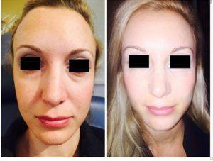 Fillers And Botox At Just Face It MedSpa, Medical Spa In The Clark County, Nevada (17)