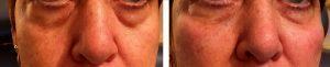 Fillers And Botox At Just Face It MedSpa, Medical Spa In The Clark County, Nevada (19)