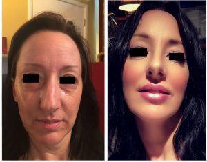 Fillers And Botox At Just Face It MedSpa, Medical Spa In The Clark County, Nevada (20)