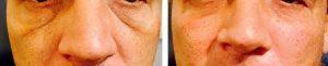 Fillers And Botox At Just Face It MedSpa, Medical Spa In The Clark County, Nevada (21)