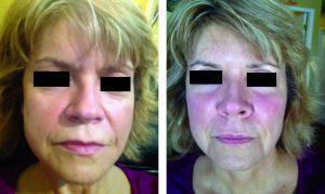 Fillers And Botox At Just Face It MedSpa, Medical Spa In The Clark County, Nevada (6)