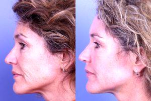 Fillers And Botox By Dr. Jeffrey Raval, MD, Denver, CO Plastic Surgeon (1)