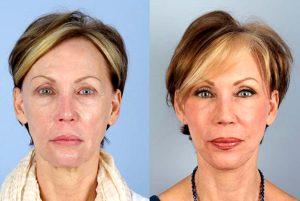Fillers And Botox By Dr. Jeffrey Raval, MD, Denver, CO Plastic Surgeon (2)