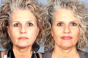 Fillers And Botox By Dr. Jeffrey Raval, MD, Denver, CO Plastic Surgeon (3)