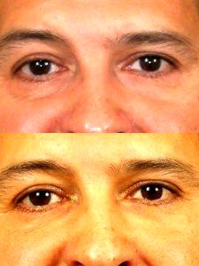 Fillers And Botox By Dr. Jeffrey Raval, MD, Denver, CO Plastic Surgeon (6)