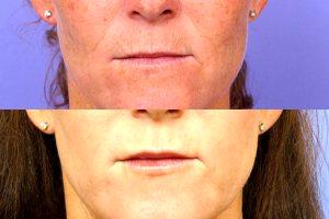 Fillers And Botox By Dr. Jeffrey Raval, MD, Denver, CO Plastic Surgeon (7)