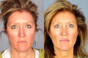 Fillers And Botox By Dr. Jeffrey Raval, MD, Denver, CO Plastic Surgeon (8)