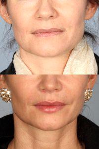 Fillers And Botox By Dr. Jeffrey Raval, MD, Denver, CO Plastic Surgeon (9)