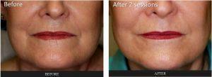Fillers At Corners Of Mouth And Cheek Fold By Dr. Tri Nguyen, Dermatologist In Houston, TX (1)