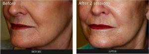 Fillers At Corners Of Mouth And Cheek Fold By Dr. Tri Nguyen, Dermatologist In Houston, TX (2)