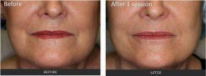 Fillers At Corners Of Mouth And Cheek Fold By Dr. Tri Nguyen, Dermatologist In Houston, TX (3)