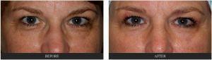 Fillers At Eyelid Hollow By Dr. Tri Nguyen, Dermatologist In Houston, TX