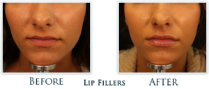 Fillers At Thrive Aesthetic & Anti Aging Center (3)