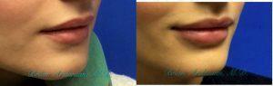 Fillers For Lips By Dr. Brian Arslanian, Plastic Surgeon In Atlanta, GA (2)