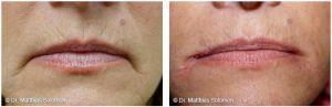 Fillers For Lips By Matthias Solomon, MD, Dallas Plastic Surgeon (2)