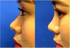 Fillers For Nose By Dr. Brian Arslanian, Plastic Surgeon In Atlanta, GA