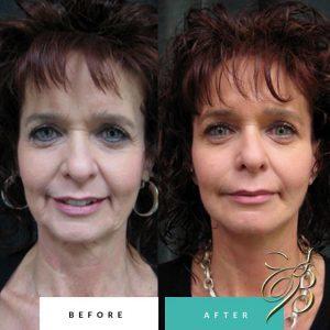 Fillers Injection By Dr. Constance Barone, Plastic Surgeon In San Antonio, Texas