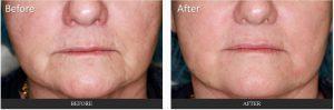 Fillers To Mouth By Dr. George G. Hughes III, MD, Dermatologist In Harris County, Texas (1)