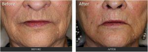 Fillers To Mouth By Dr. George G. Hughes III, MD, Dermatologist In Harris County, Texas (2)