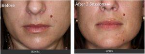 Fillers Under Eye Hollow, Cheek Bone Fold, And Corners Of Mouth By Dr. George G. Hughes III, MD, Dermatologist In Harris County, Texas (1)