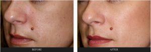 Fillers Under Eye Hollow, Cheek Bone Fold, And Corners Of Mouth By Dr. George G. Hughes III, MD, Dermatologist In Harris County, Texas (2)
