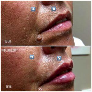 Fixing Asymmetric Lips With Filler And Botox By Scottsdale Plastic Surgeon, Dr. John J. Corey, MD
