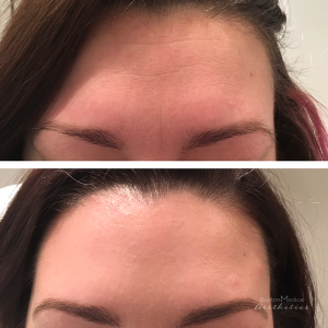 Forehead And Frown Lines By JENNIFER CANESI, APN-BC, Board Certified Adult Nurse Practitioner In Boston