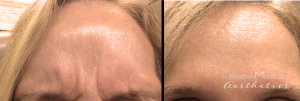Forehead Botox At Boston Medical Aesthetics (2)