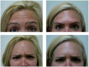Forehead Botox By Clayton Frenzel, Doctor In Arlington, Texas