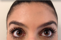Forehead Botox By Dr. Asif Pirani, MD, FRCS(C), Toronto Plastic Surgeon