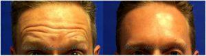 Forehead Botox By Dr. Brian Arslanian, Plastic Surgeon In Atlanta, GA
