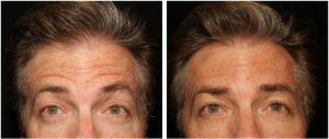 Forehead Botox By Dr. David Verebelyi, MD, Englewood, CO Plastic Surgeon (1)