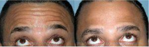 Forehead Botox By Dr. Jose Perez-Gurri, Plastic Surgeon In Miami, FL