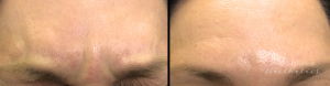 Forehead Botox By Dr. Michael Tantillo, Boston Plastic Surgeon (1)