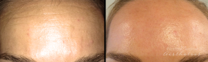 Forehead Botox By Dr. Michael Tantillo, Boston Plastic Surgeon (2)