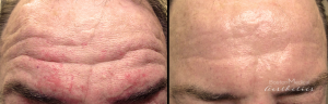 Forehead Botox By Dr. Michael Tantillo, Boston Plastic Surgeon (3)