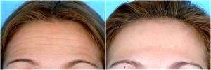 Forehead Botox By Dr. Steven H. Dayan, MD, Doctor in Chicago, Illinois