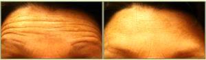 Forehead Botox By Dr. Tricia Brown, Dermatologist In Houston, TX