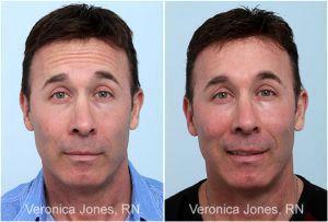 Forehead Botox By Veronica Jones, RN At Mirror Mirror Beauty Boutique In Houston, Texas