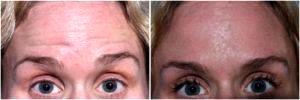 Forehead Botox By at Gold Coast Plastic Surgery, Chicago, IL