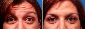 Forehead Botox Injections By Dr. Steven Pearlman, Plastic Surgeon In New York City, New York