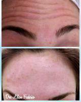 Forehead Botoxijections Before After