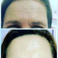 Forehead Cosmetic Improvement