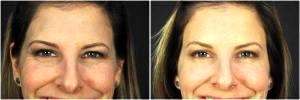 Forehead & Crowsfeet Botox By Goesel Anson, MD, FACS, Plastic Surgeon In The Clark County, Nevada (4)